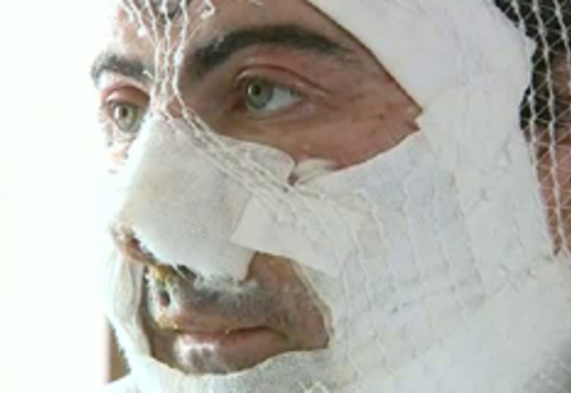 06/04/11 : Deux personnes brûlées au laetare